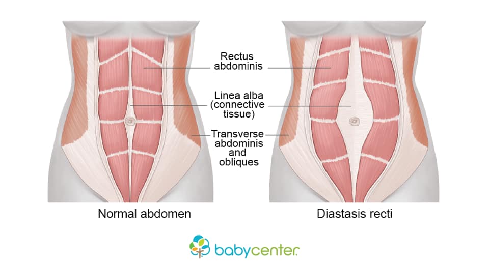 Abdominal separation or diastasis recti in women post-childbirth.
