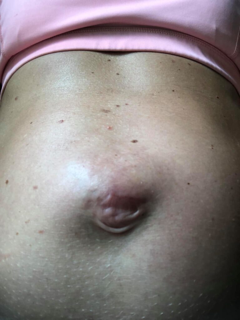 Photo of my tummy pre umbilical hernia surgery and diastasis recti repair.